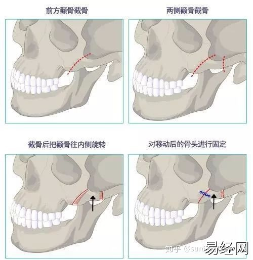 男人额头窄颧骨宽面相_男人颧骨高额头窄面相_颧骨高下颌角宽额头窄面相