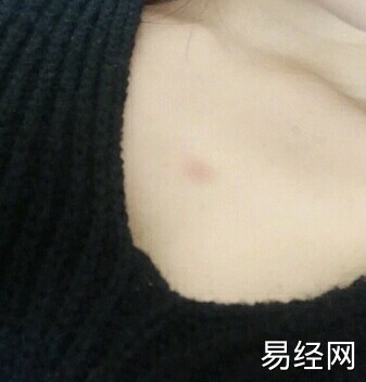 私密有痣代表什么?女人乳晕上长痣有什么含义?