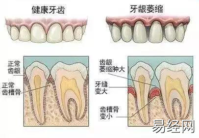 牙缝太大，吃东西老塞牙怎么办？我的牙缝好大？