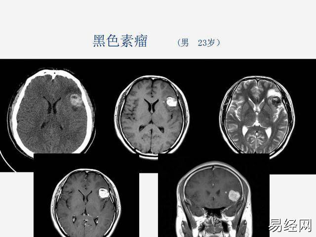 “痣会恶变”是良性肿瘤，去除不当反易发生癌变